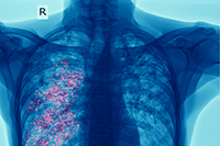 VA Finds Biomarkers That Can Predict Lung Disease